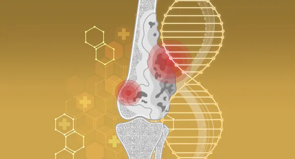 Hemostasis Abnormalities in Multiple Myeloma