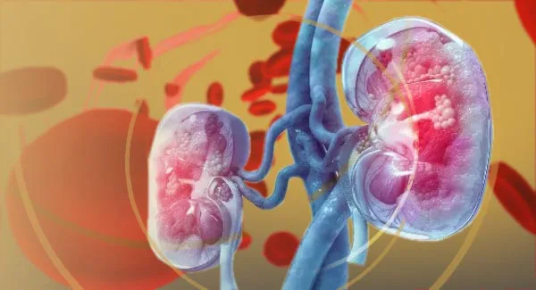 Optimizing Anemia Treatment in CKD: Epolix & Cardiovascular Risk Reduction